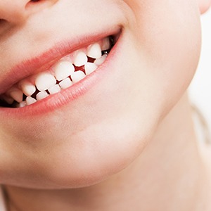 Direct bonding is a pain-free procedure that repairs damaged teeth in Naperville, IL